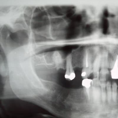 Röntgenkuva leuasta ja hampaista, joista osa on korvattu kullalla