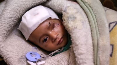 Det nyfödda barnet Karim har skadats två gånger i bombräder i Ghouta. Han har förlorat sitt öga och sin mamma. 