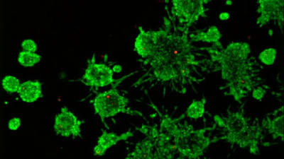 Tre-dimensionell (3D) cellkultur av aggressiva prostatacancer celler (gröna) som invaderar ut i den närliggande omgivningen.