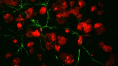 Tre-dimensionell (3D) co-kultur av prostatacancerceller (röda) som tillsammans med fibroblaster (gröna) bildar en mikrovävnad. Mikrovävnaden kan användas för läkemedelstest in vitro (i cellskål).
