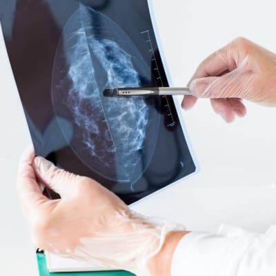 Rinnan mammografiakuva lääkärin hansikoiduissa käsissä. 
