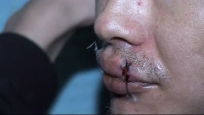 En av fångarna i Bishkek  fängelse har sytt ihop sina läppar i prtest mot usla förhållanden