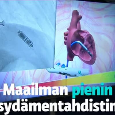 Uutisvideot: Uudenlaisia sydämentahdistimia on asennettu vajaan vuoden ajan Suomessa