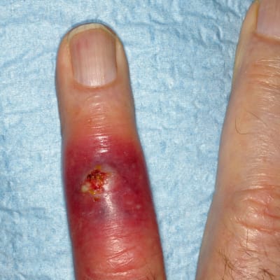 Äreän punainen tulehdus sormessa, keskellä avohaava. 