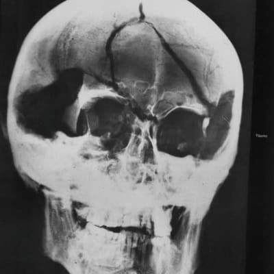 Röntgenkuva Kaarle XII:n kallosta viimeisimmästä ruumiinavauksesta vuodelta 1917. Tuolloin Kaarlen Riddarholmenin kirkkoon haudatut muumioituneet jäänteet myös röntgenkuvattiin