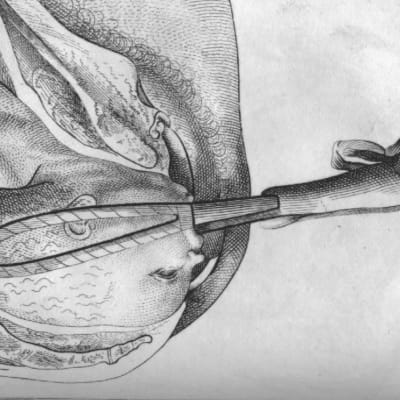 Historisk, tecknad bild: Tångförlossning 1792. 