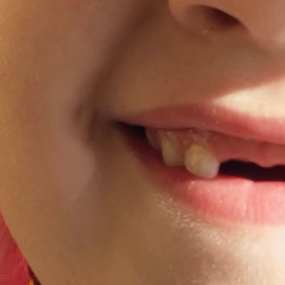Pienen tytön suu ja kaksi irronnutta hammasta