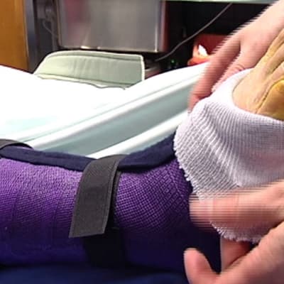 Luunmurtumaa hoidetaan, violetti kipsi jalassa.