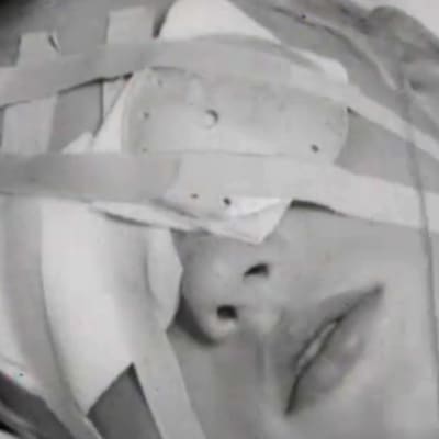 Tapaturmaisesti silmänsä loukannut poika (1953).