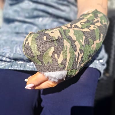 En persons hand, med ett gips som har kamouflagemönster. Kvinnans naglar är målade rosa.