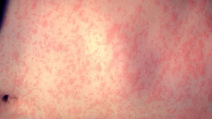 Mässling kan leda till hjärnhinneinflammation. Mässling