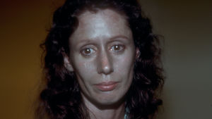 Rosemary Jacobs på 1970-talet innan en läkare slipade bort den yttersta huden i hennes ansikte. Rosemary Jacobs på 1970-talet innan en läkare skalade av huden i hennes ansikte.