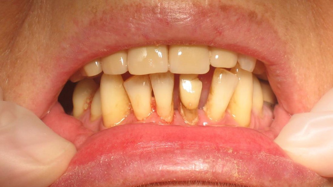 inflammation i tandbenet inflammation i tandbenet