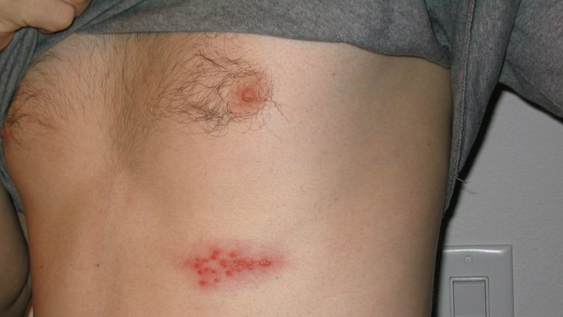 herpes utslag på ryggen herpes utslag på ryggen