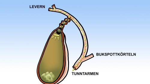hur lång tid tar en gallstensoperation hur lång tid tar en gallstensoperation