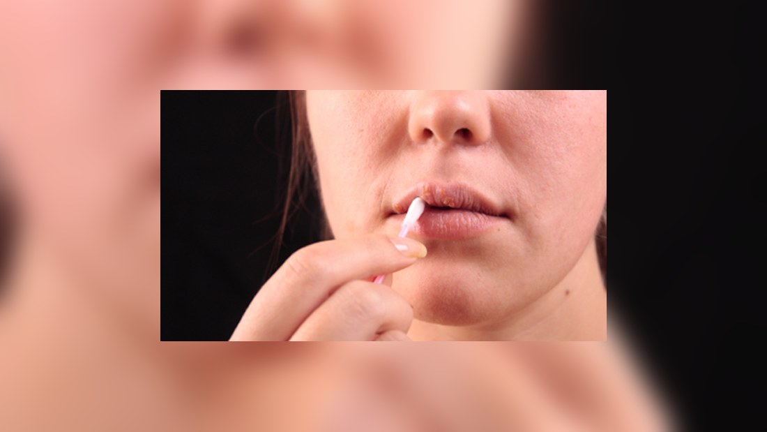 när slutar herpes smitta när slutar herpes smitta