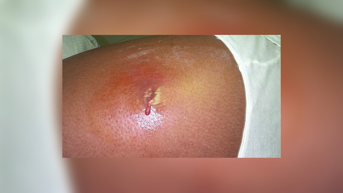 infektion i kroppen utan feber infektion i kroppen utan feber