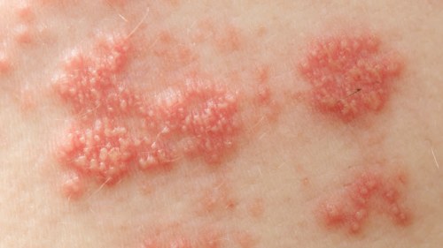 herpes hud behandling herpes hud behandling
