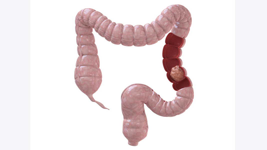 Tjocktarmscancer screening av bdoktorn Hälsa svenska.yle.fi