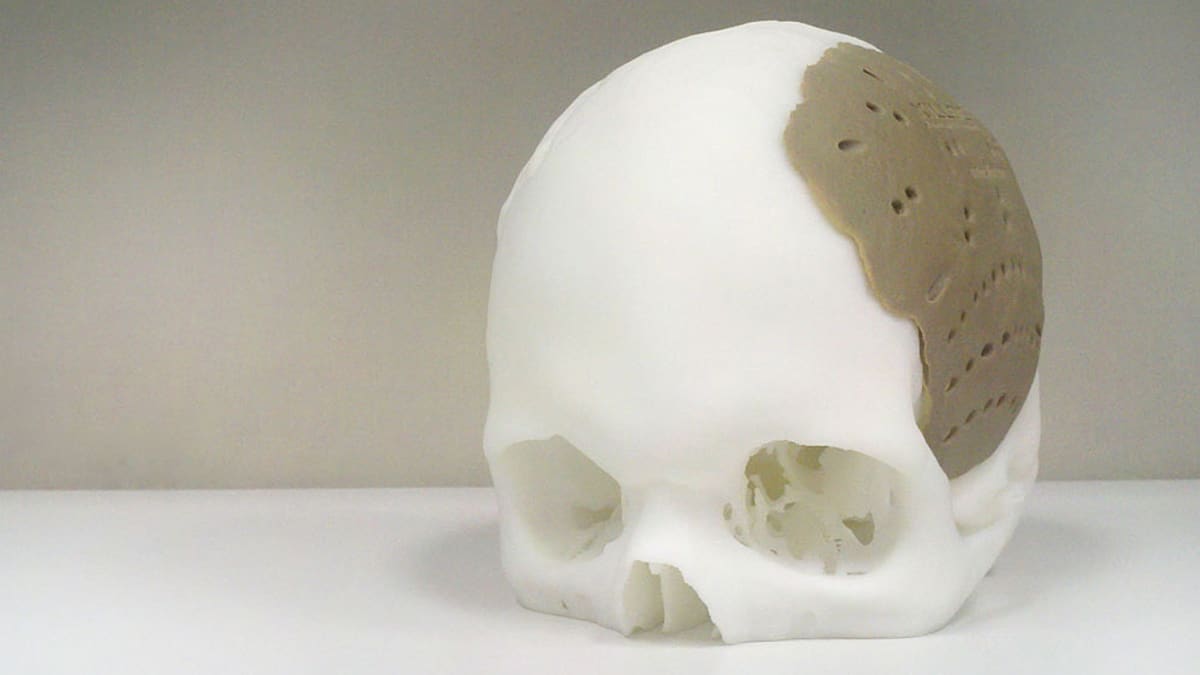 3D-tulostuksella luotu kalloimplantti.