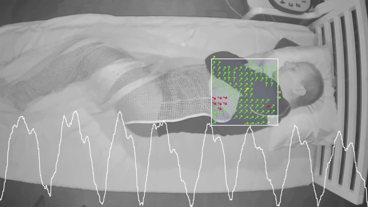 Konennäkö tarkkailee epilepsiapotilaan unta