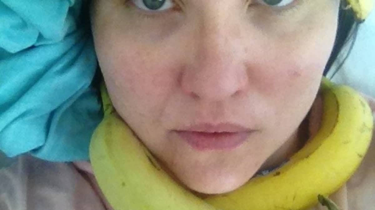 Maaria Oikarinen koristeli itsensä banaaneilla sairaalassa.