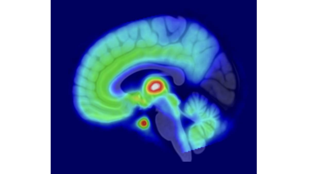 Aivojen opioidireseptorien näkyminen aivokuvissa.