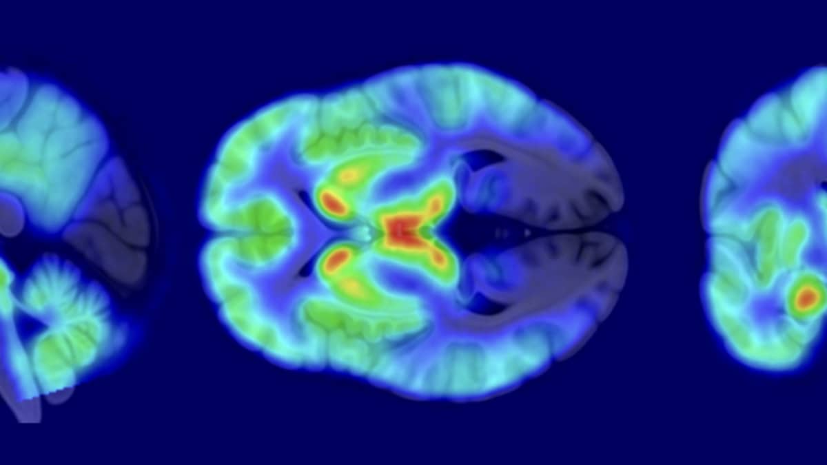 Aivojen opioidireseptorien näkyminen aivokuvissa.