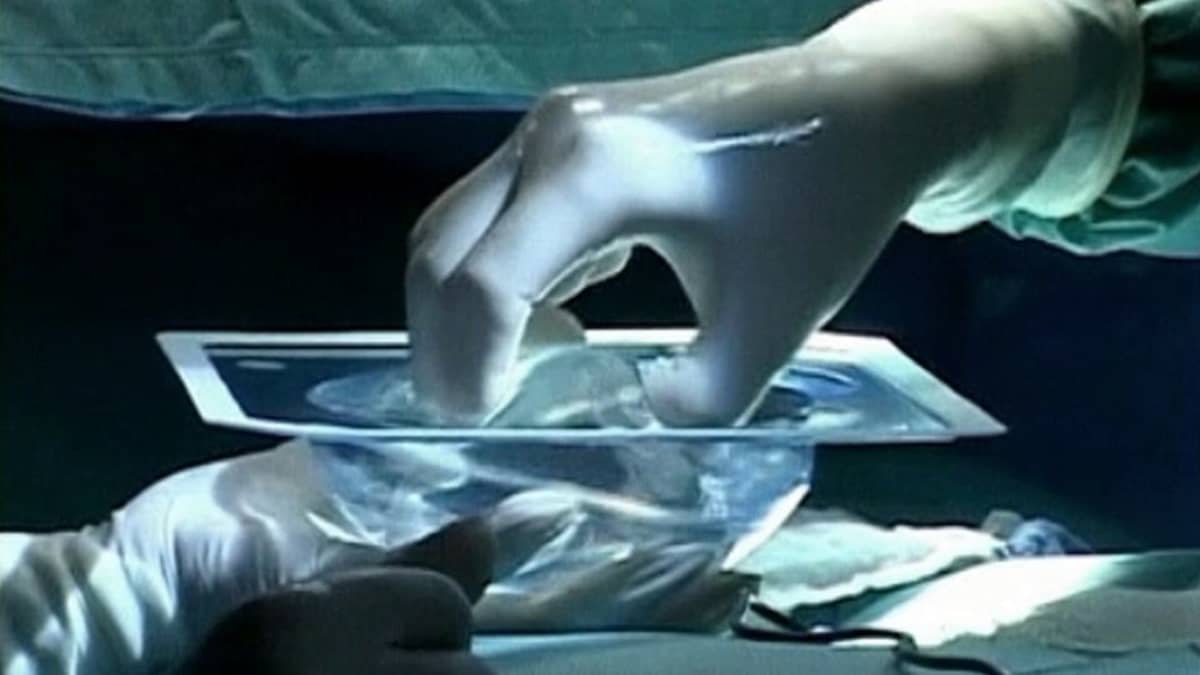 Käsi poimii implantin kotelosta