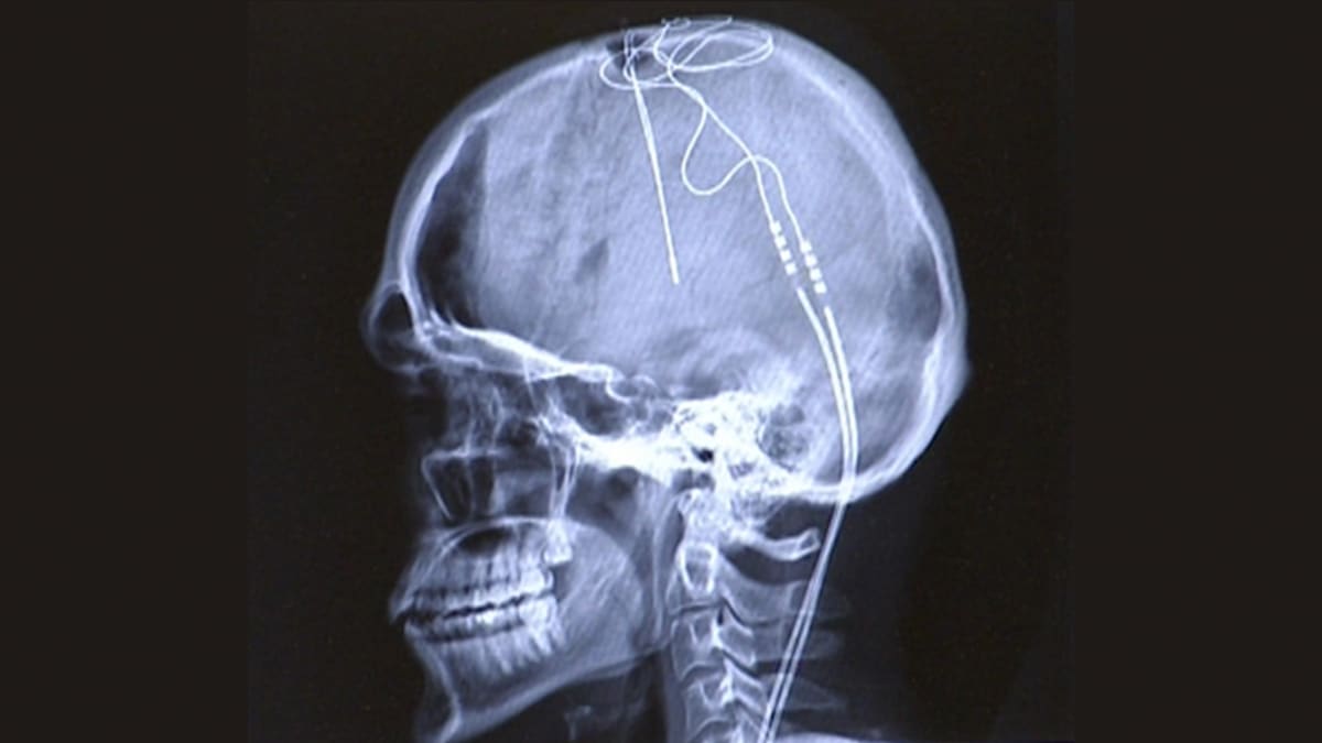 Röntgenkuva päähän sijoitetuista johdoista.