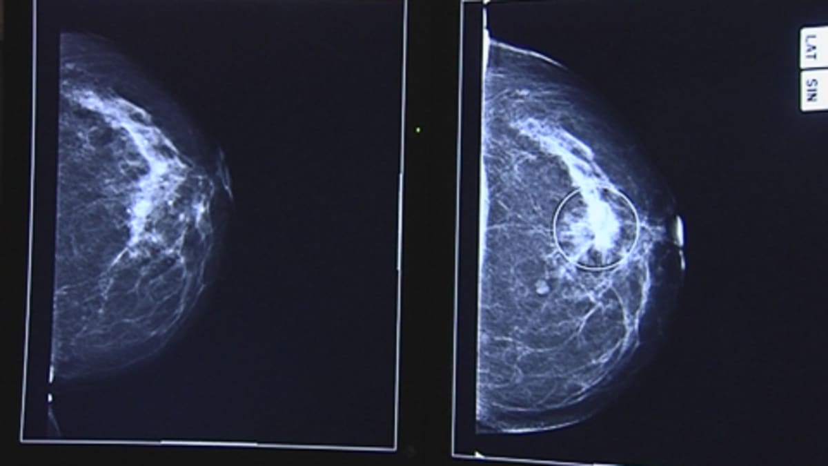 Röntgenkuva kasvaimesta rinnassa