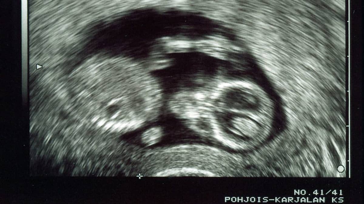 Ultraäänikuvassa muutaman kuukauden ikäinen sikiö.