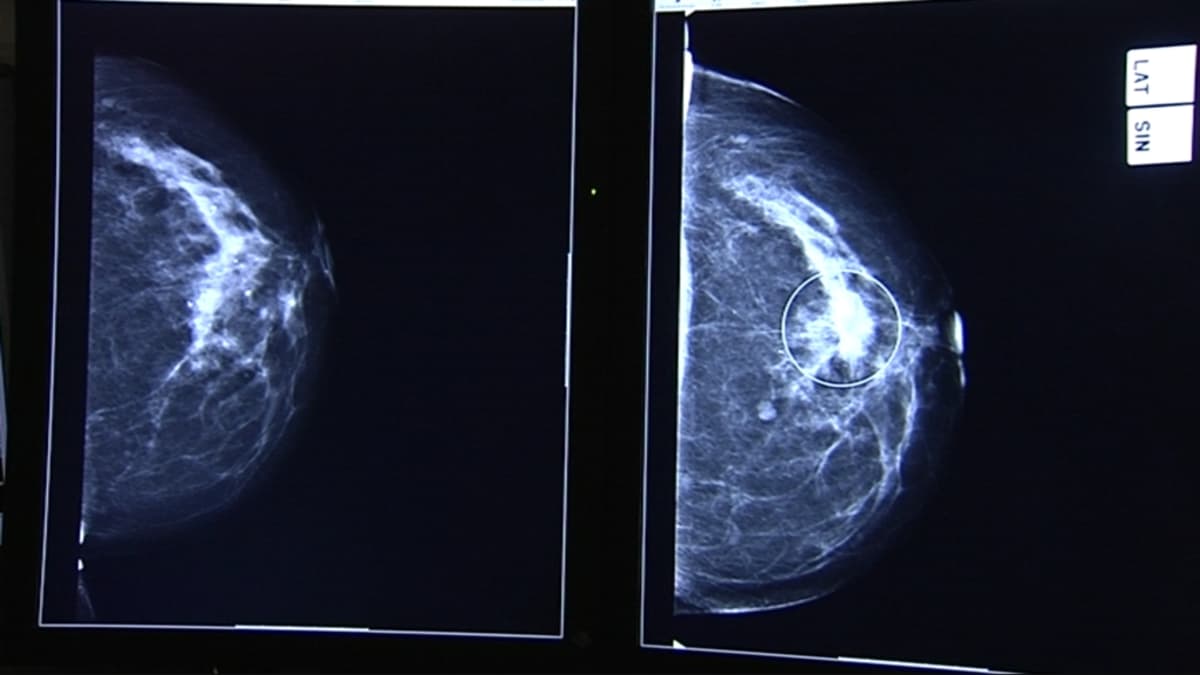 Lääkärit lähettävät oireettomia naisia mammografiaan, vaikka se ei  välttämättä tunnista syöpää – voi johtaa jopa turhiin rintaleikkauksiin