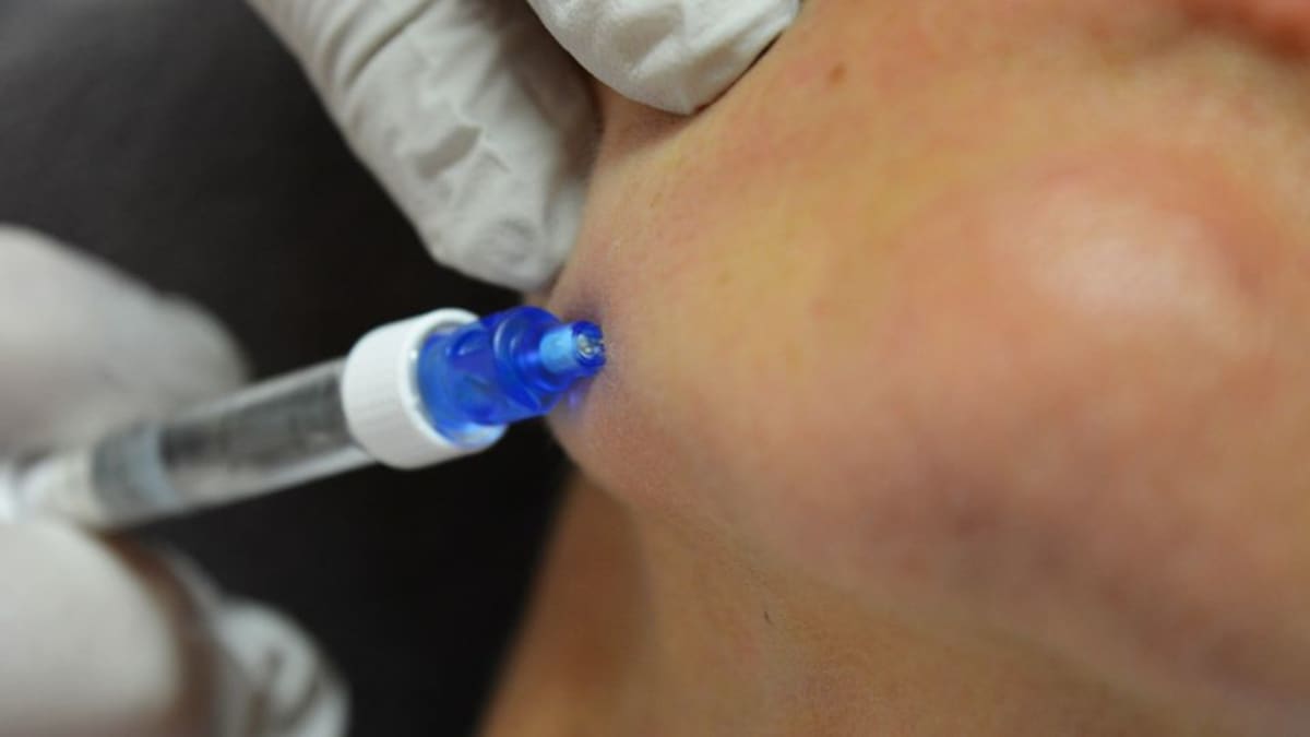 Botox-huulet ovat harhaluulo – "Huulet olisivat kokonaan lamaantuneet ...