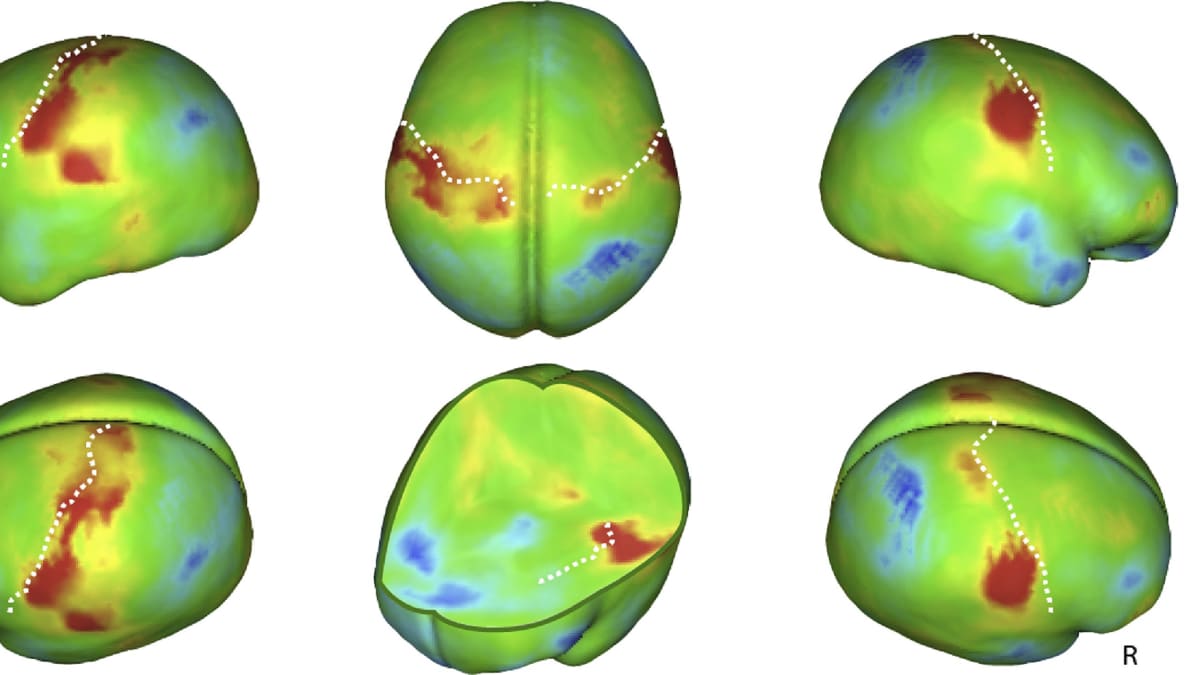 Aivojen aktivaatiokartassa näkyy, mitkä alueet reagoivat hellään silittämiseen.