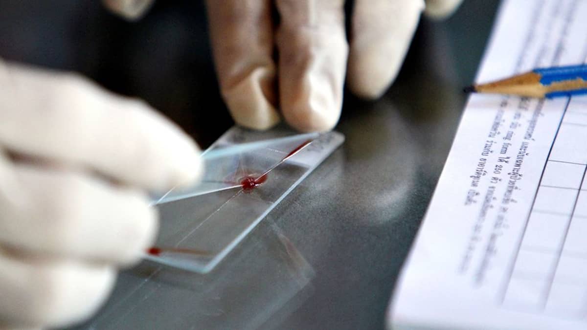 Verinäytettä valmistellaan malariatestiä varten.