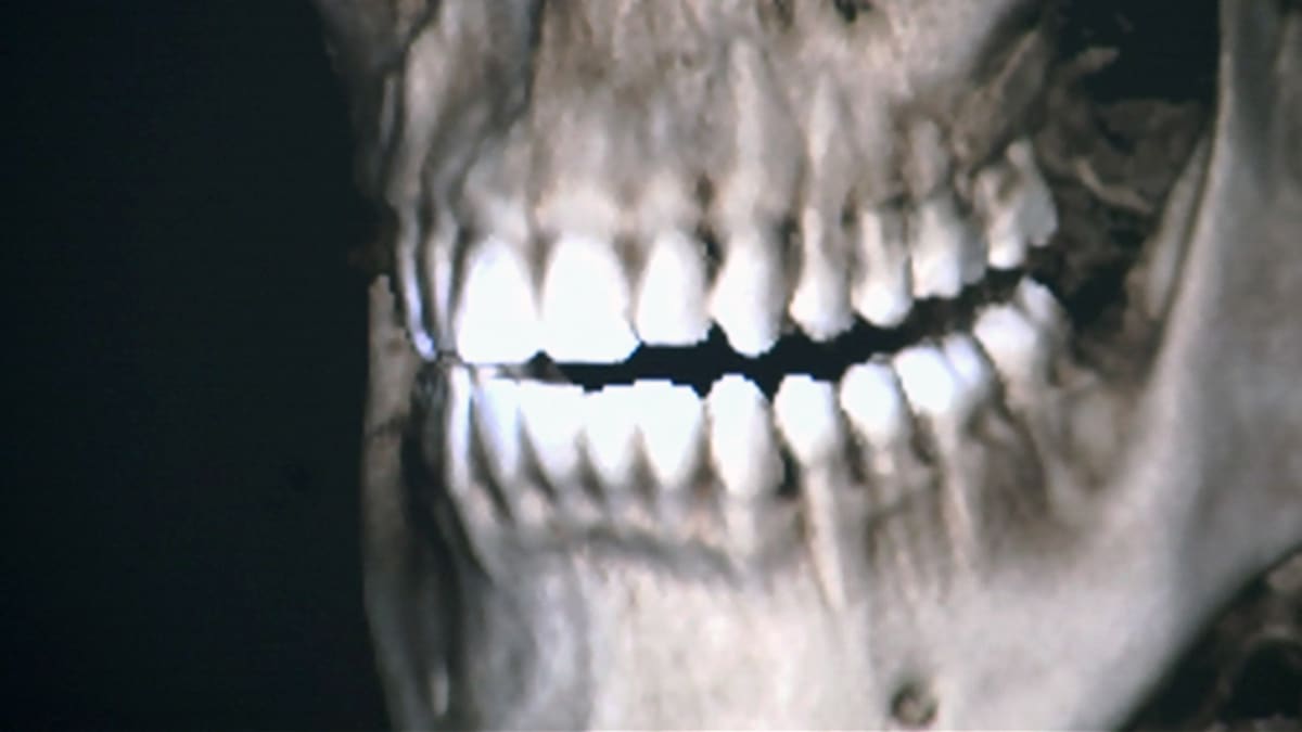 Röntgenkuva hampaista.