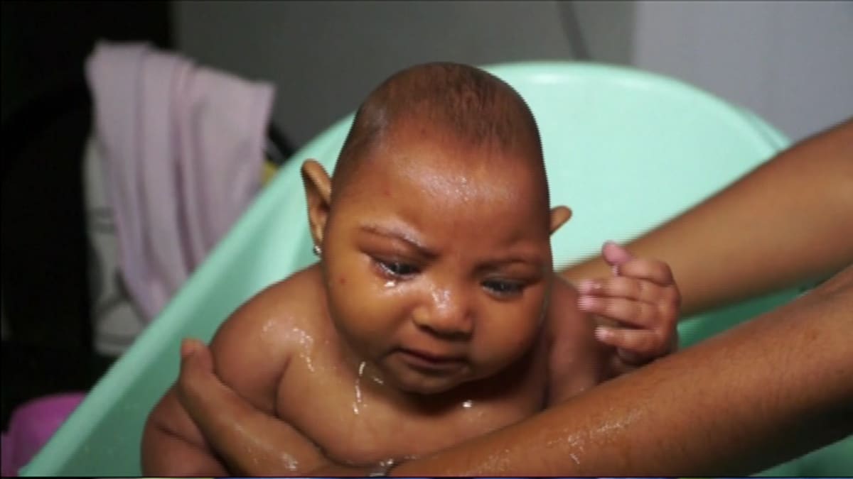 Pienipäisenä zika-viruksen takia syntynyt brasilialaisvauva