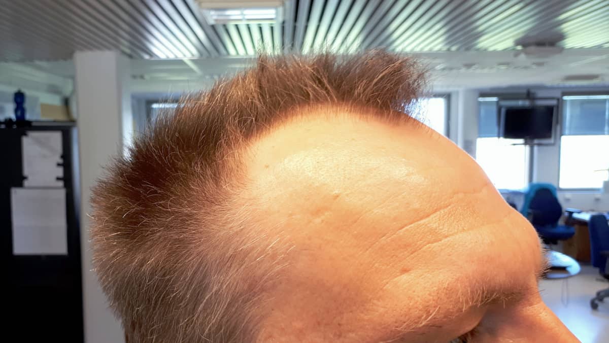 Avolava" On Alle 30-Vuotiaan Miehen Painajainen – Ei Hätää, Sillä Näin Kaljuuntuvaa Päätä Voi Hoitaa