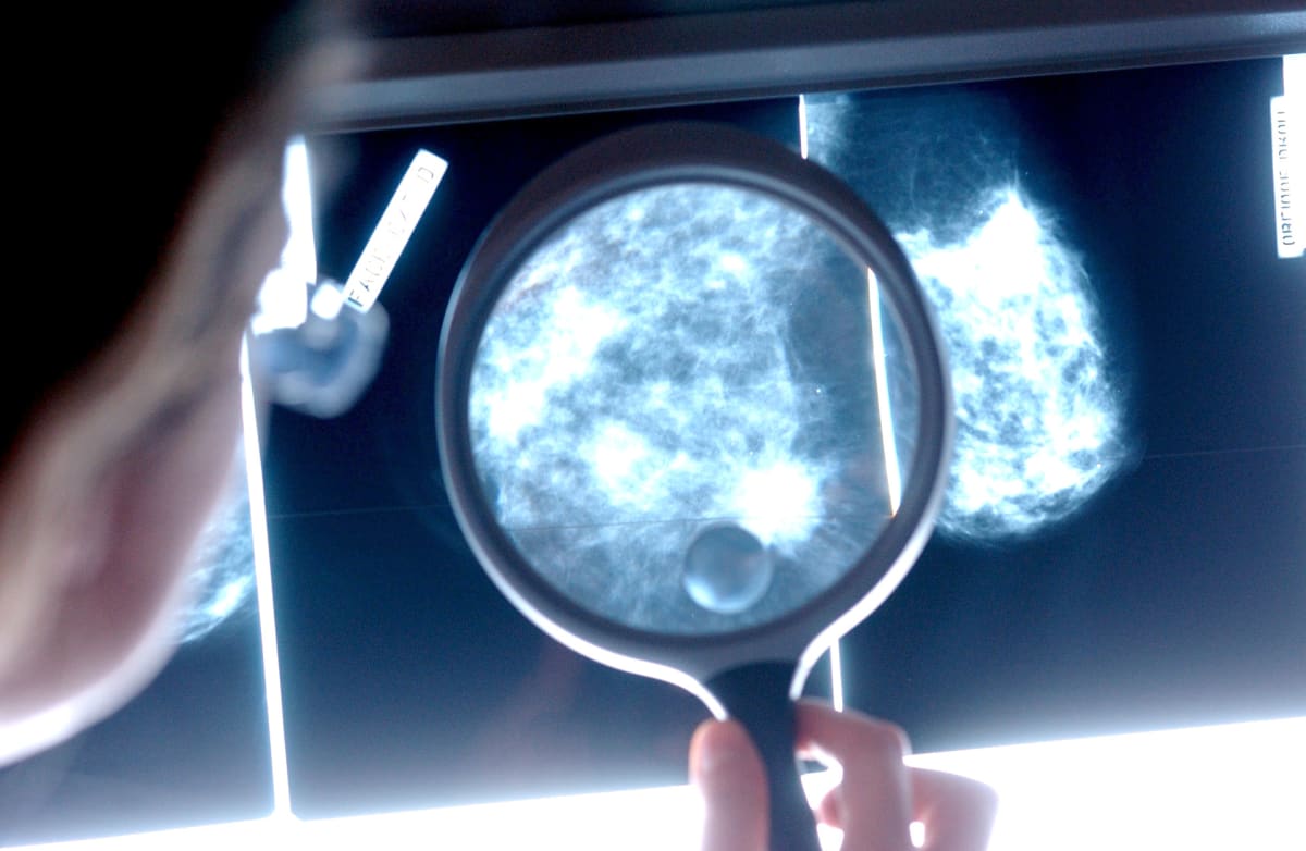 Lääkäri tutkii syöpäkasvainta mammografiakuvasta.