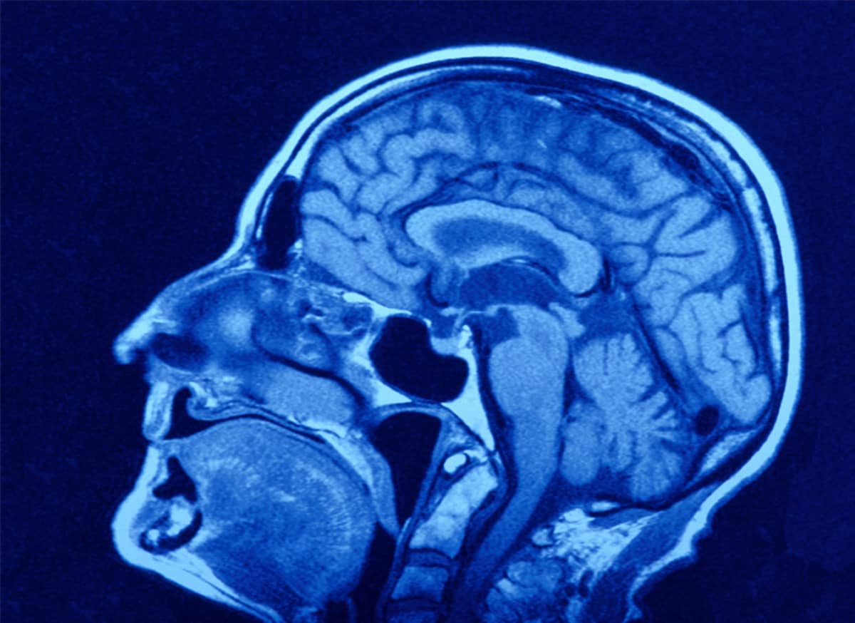 CT-kuva päästä, jossa näkyy kallon luita ja mm. aivot.