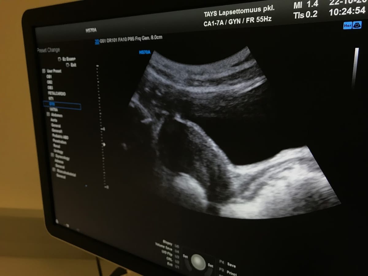 Ultraäänikuvaa lapsettomusklinikan monitoriruudulla