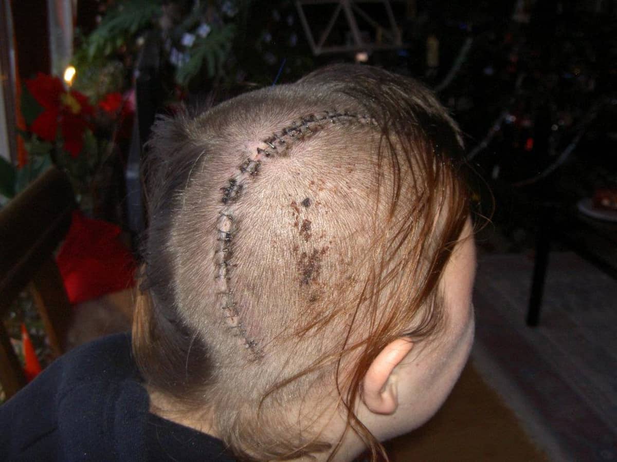 Julia Ala-Harja otti talteen päänsä leikkaushaavan lukuisat hakaset, joista isosisko teki hänelle muistoksi kaulakorun.