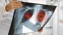 Lääkäri tutkii keuhkoista otettua röntgenkuvaa.