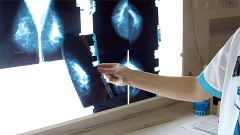 Lääkäri tutkii mammografia-kuvia.