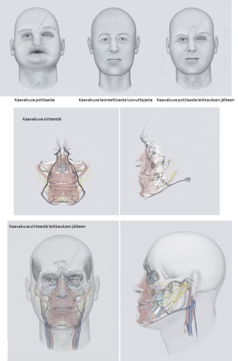 Havainnekuvia HUS:ssa tehdystä kasvojen siirteestä ennen ja jälkeen leikkauksen. Kuva ei esitä potilasta, vaan on piirtäjän näkemys asiasta.