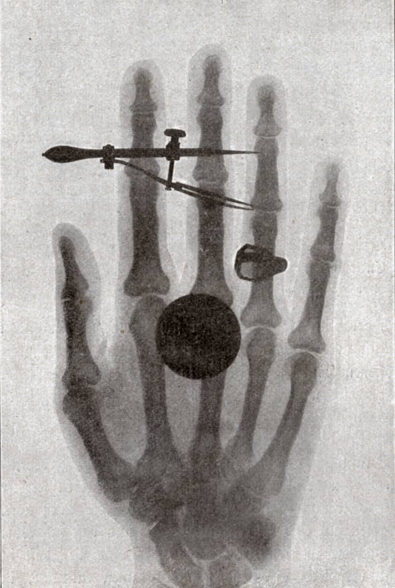 Wilhelm Röntgenin vaimon läpivalaistu käsi.